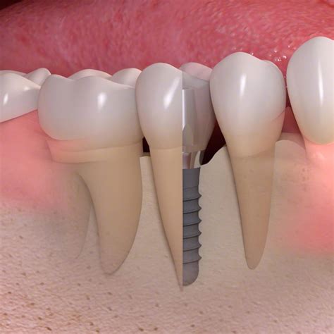 Implantes Dentales De Titanio Cl Nica Dental S Nchez Del Campo