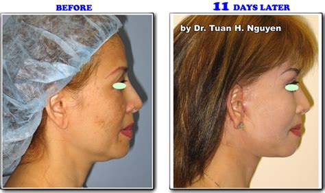 Facial Plastics Noble Care Outpatient Surgery Center Youngandpretty
