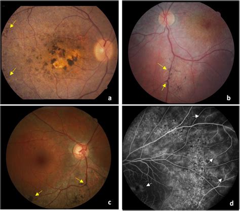 Fundus Appearance From Crb1 Patients A Color Fundus Photograph Of
