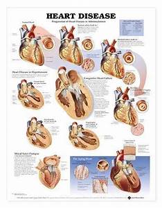 Heart Disease Chart Charts Models Anatomical 14 95 Picclick