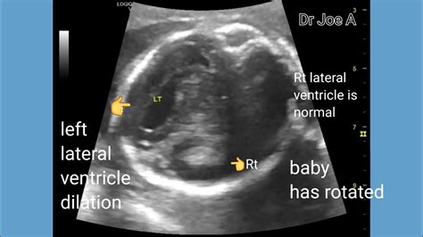 Mild Unilateral Dilation Lateral Ventricle In Fetus Unilateral