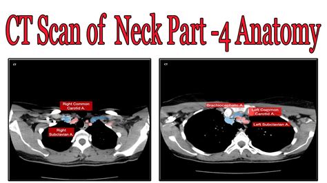 Ct Scan Of Neck Axial Part 4 Anatomy Youtube