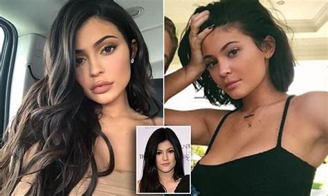 plastic surgeon on how kylie jenner s lip fillers are dissolved daily mail online