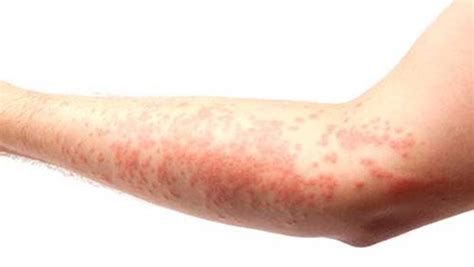 Skin Cancer Rash On Arms Idaman