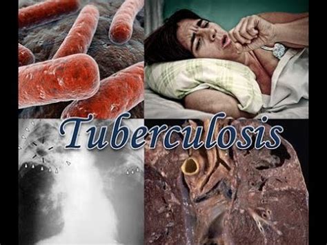 Most infections show no symptoms, in which case it is known as latent tuberculosis. Tuberculosis - YouTube