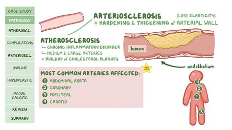 Atherosclerosis Pathology Review Osmosis