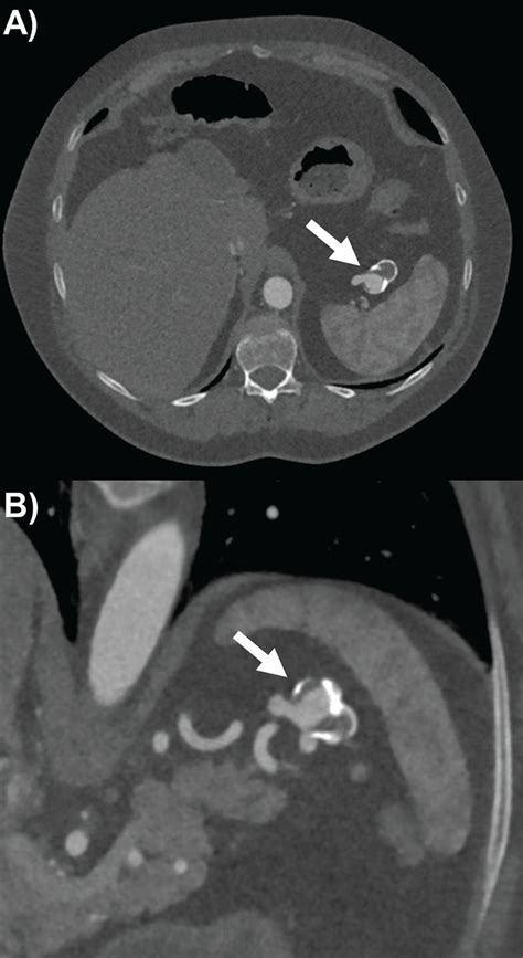 Optimal Surveillance And Treatment Of Renal And Splenic Artery