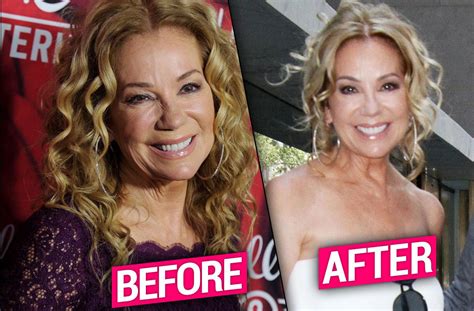 Kathie Lee Gifford Plastic Surgery Makeover Exposed By Top Doctors