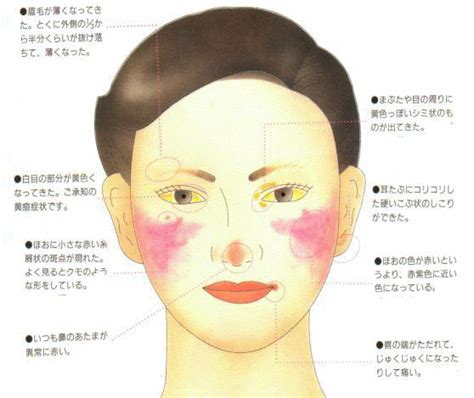 粘液水腫 いつも鼻の頭が異常に赤い