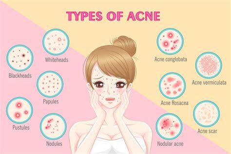 What Type Of Acne Do I Have 6 Types Of Acne Explained Artofit