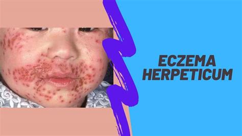 Eczema Herpeticum Causes Diagnosis And Treatment