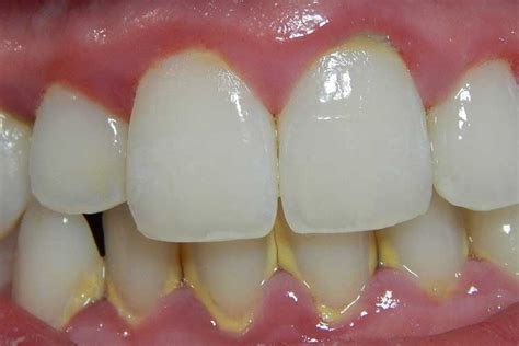 Gum Disease Gingivitis And Periodontitis Ausmed