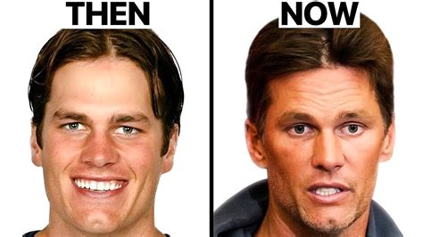 Did Tom Brady Have Plastic Surgery Surgeon Reacts Oasis Medical
