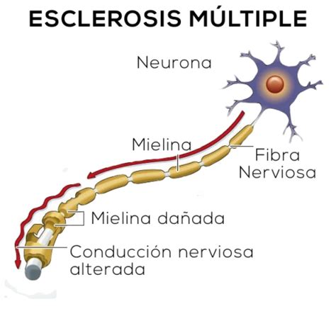 Esclerosis múltiple la esclerosis multiple (em) es una enfermedad autoinmunitaria que afecta el cerebro y la médula espinal (sistema nervioso central). Me han diagnosticado Esclerosis Múltiple...¿Qué es la ...