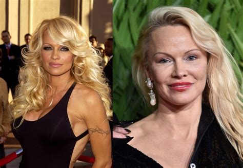Celebrities After Failed Plastic Surgery Bestpositive Vrogue Co