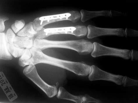 Metacarpal Fracture Treatment In Raleigh Nc By Dr Erickson