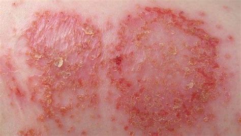 Most Common Skin Rashes In Adults