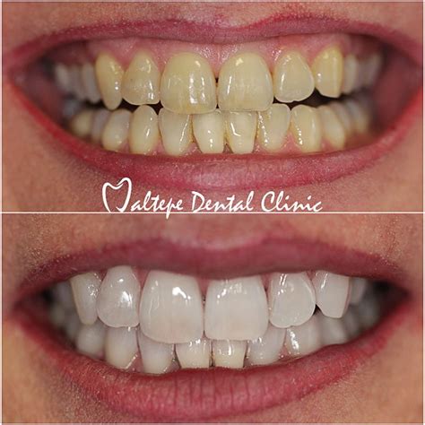Teeth Whitening Maltepe Dental Clinic