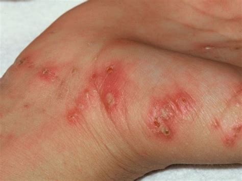 Scabies Symptoms And Signs Causes Treatment Prevention