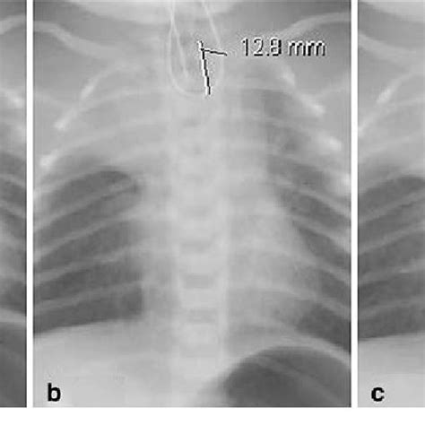 A Preoperative Chest X Ray Displaying A Curled Nasogastric Tube In