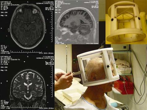 Stereotactic Mri Localizer On The Left Triplanar Mri Images In