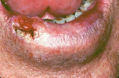 Squamous Cell Carcinoma Mouth Dorothee Padraig South West Skin Health