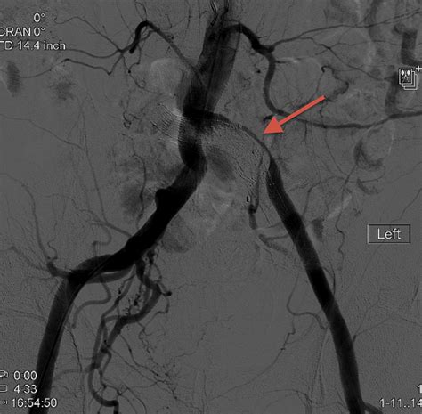 Iliac Artery Stenosis Complicating Iliac Vein Stenting In A Patient