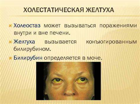 Желтуха а диета Желтуха У Взрослых Симптомы И Лечение Диета — Похудение Диета Желтуха У Взрослых Симптомы И Лечение Диета — Похудение Диета Желтуха а диета