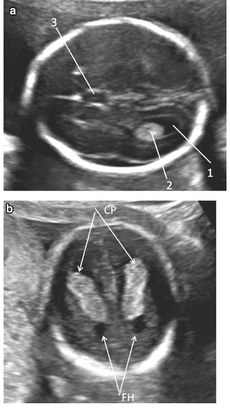 A Transverse Axial Scan At The Level Of Lateral Ventricles 1 Lateral