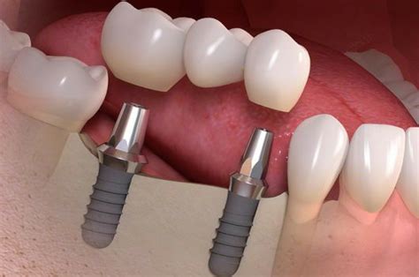 Implantologia Dental Alianza Dental MX