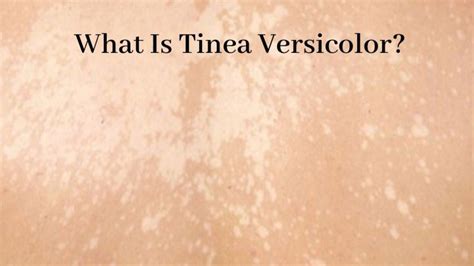 Is Tinea Versicolor Contagious Causes Symptoms And Natural Remedies