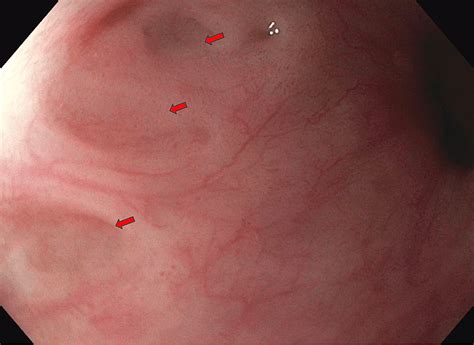 Cureus Outpouching In The Esophagus An Uncommon Endoscopic Finding Of Esophageal Intramural