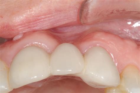 When To Bone Graft After Tooth Extraction When To Bone Graft After