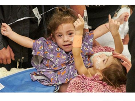 Conjoined Twins Undergo Successful Separation Surgery At Stanford