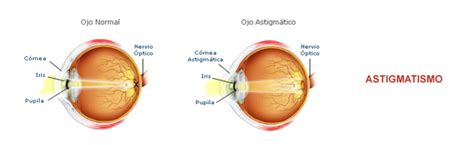 Qué es el astigmatismo y cómo se corrige Oftalmologo Sevilla