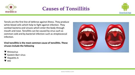Ppt Tonsillitis Typescausessymptomsdiagnosisprevention And