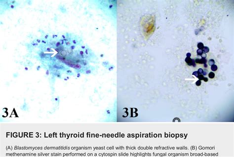 Figure 3 From A Case Report Of Disseminated Blastomycosis With Thyroid Involvement In A Pregnant