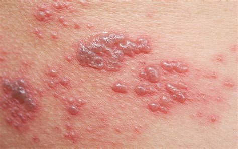 Common Skin Lesions Types Causes Symptoms And Treatments Vedix