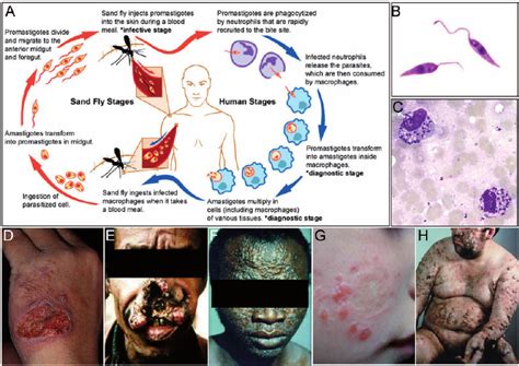 Leishmania Life Cycle And Clinical Syndromes A Diagrammatic My XXX Hot Girl