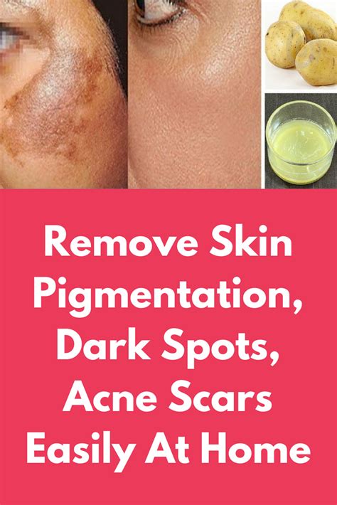 How To Get Rid Of Birthmarks Fast At Home Arvigy