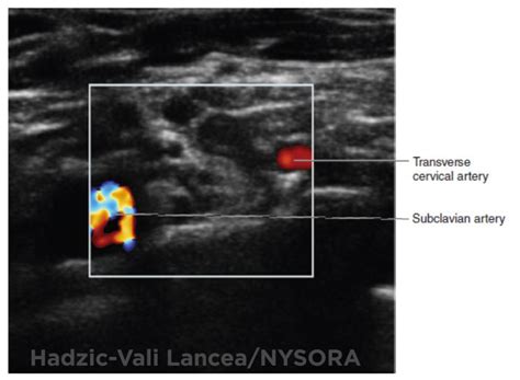 Introduction To Ultrasound Guided Regional Anesthesia Nysora The New