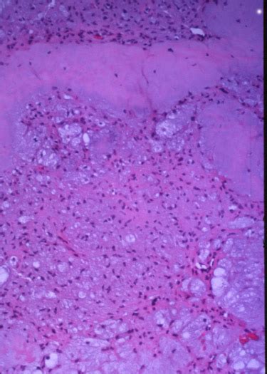 Chondromyxoid Fibroma Pathology 10x