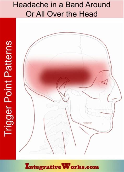 Trigger Point Patterns Headaches Cervicogenic Integrative Works