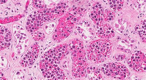 Intravascular Diffuse Large B Cell Lymphoma Atlas Of Pathology