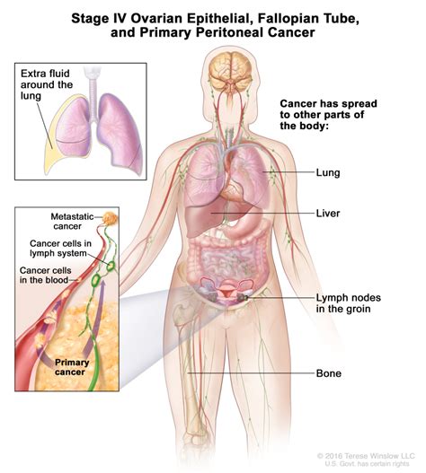Stage 4 Cancer Lymph Nodes