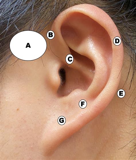 The Differences Between 2 Cases Of Preauricular Fistula Ye Jin Cho