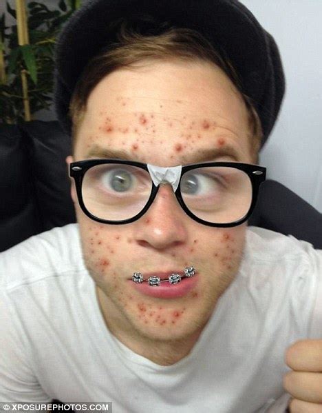 X Factor Heart Throb Olly Murs Dons Zits Braces And Glasses In Geeky