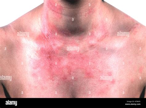 Allergic Contact Eczema Dermatitis Rash Hi Res Stock Photography And