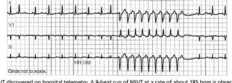 Figure 16 From Nonsustained Ventricular Tachycardia In The Normal Heart