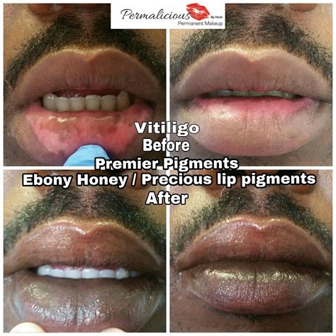 Vitiligo Lips Corrective Permanent Makeup Procedure Permanent Lipstick